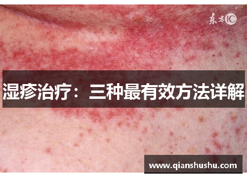 湿疹治疗:三种最有效方法详解